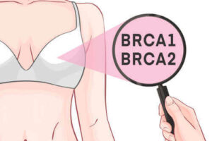 BRCA-1 및 BRCA-2 유전자와 유방암