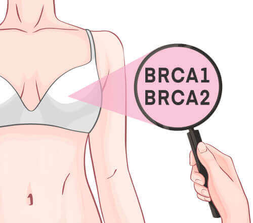 BRCA-1 및 BRCA-2 유전자와 유방암