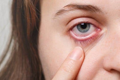 눈 편두통은 어떤 영향을 미칠 수 있을까?