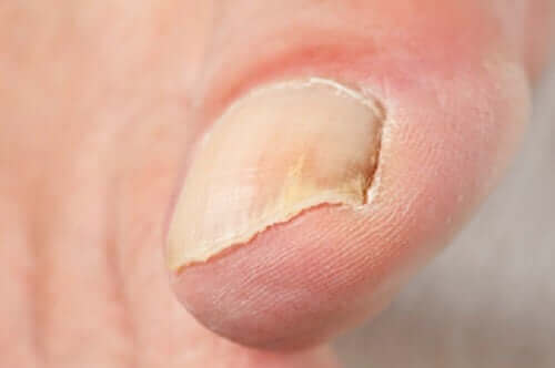 손발톱진균증 치료법은 효과가 있을까?
