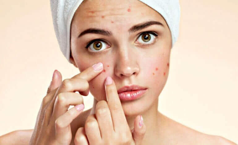 3. Toothpaste can get rid of acne 