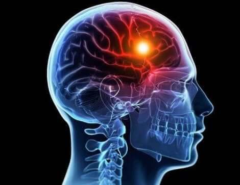 뇌색전증은 무엇이며 어떤 영향을 미칠까