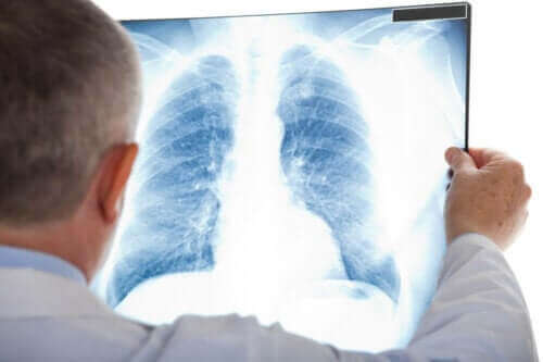 비정형 폐렴은 무엇인가