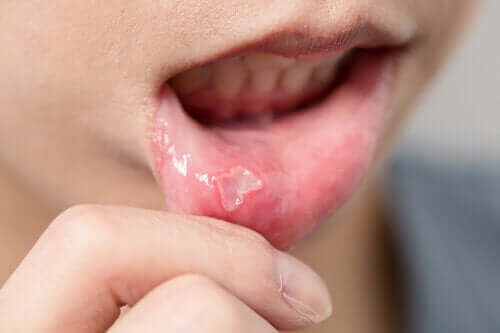 어린이 입술포진 치료법