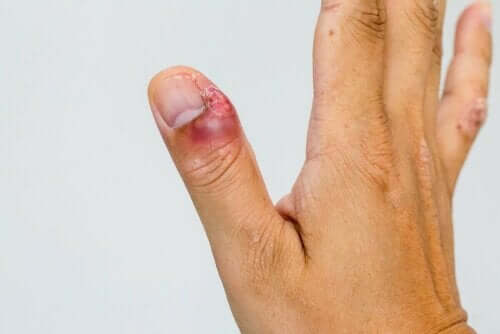 손발톱 주위염의 특성 및 치료