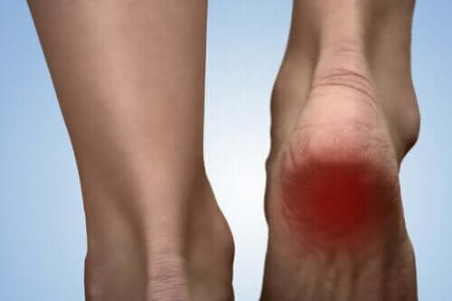 발뒤꿈치 통증 증후군을 위한 5가지 치료법