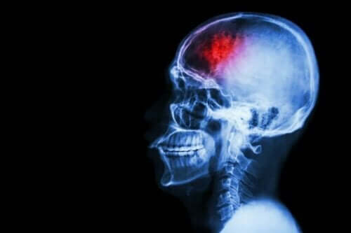 뇌졸중 예방 조치 7가지