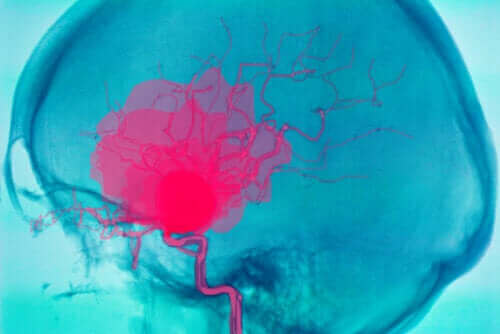 뇌내출혈은 무엇일까