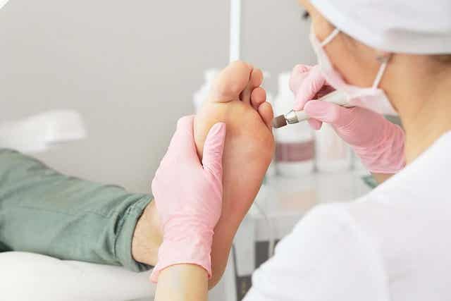 손발에 생긴 굳은살에 대한 의학적 치료