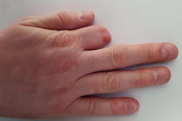 사고로 인한 손가락 절단에 대한 응급 처치