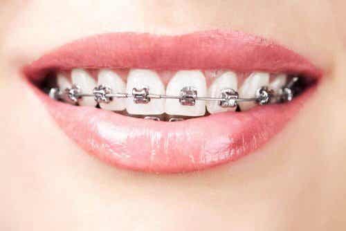 치아 교정 치실