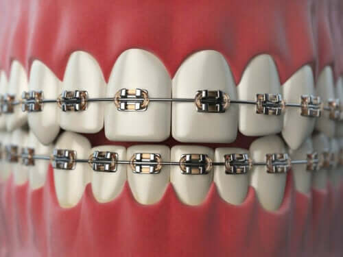 치아 교정 중 유의 사항 8가지