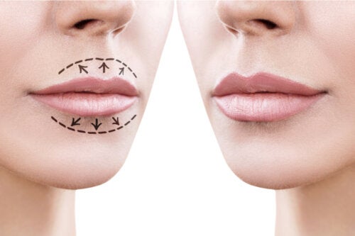 입술 성형술은 무엇일까?