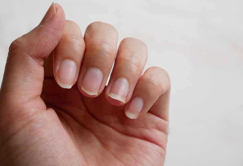 손발톱 세로 갈림증의 정의 및 치료