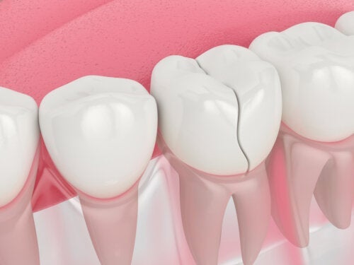 치아 균열 원인과 치료