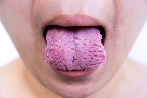 갈라진 혀 또는 균열설 원인과 치료